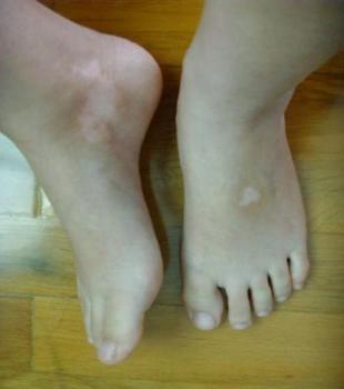 脚部白癜风早期症状有哪些